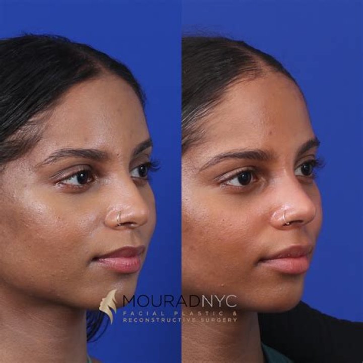 Taylor Love Is Blind Plastic Surgery | Nose Job Before And After